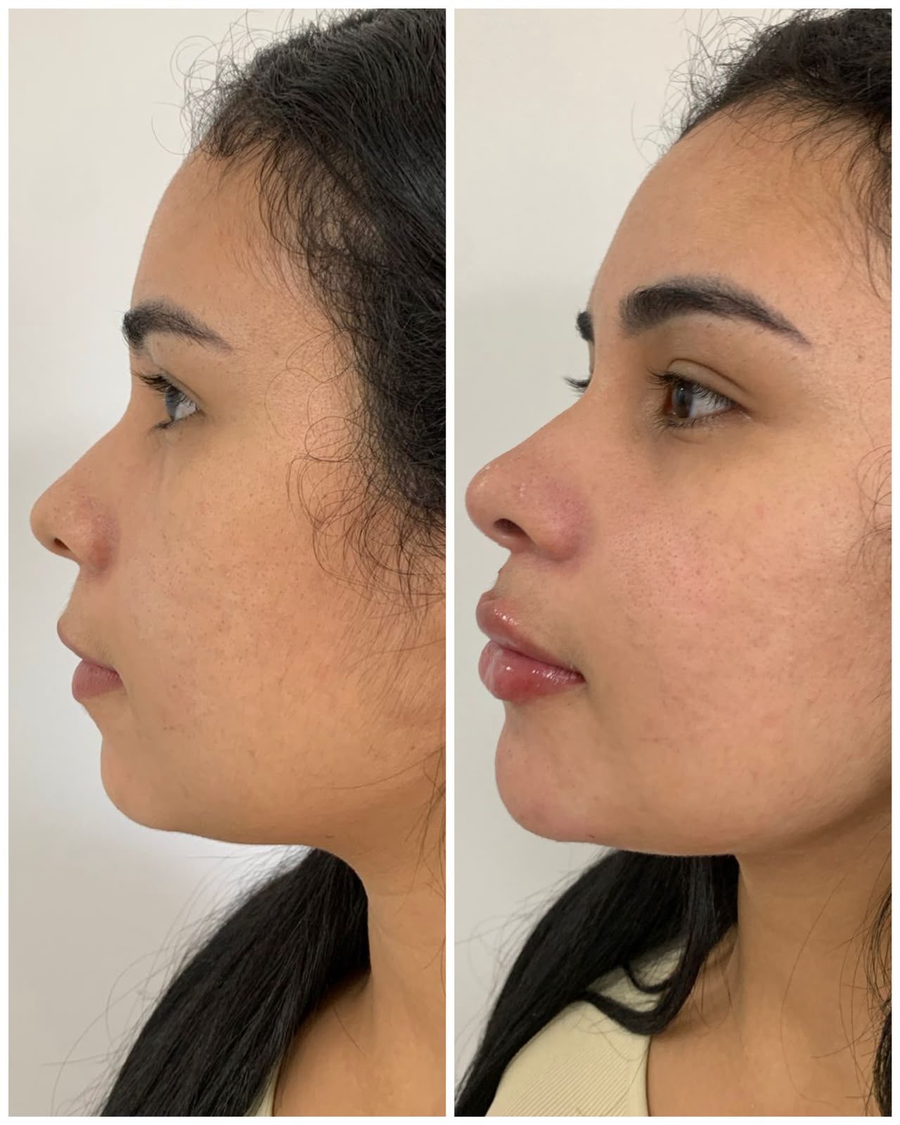 Radiofrequência Microagulhada em Porto Velho - RO — Fabiana Rocha Centro de Estética