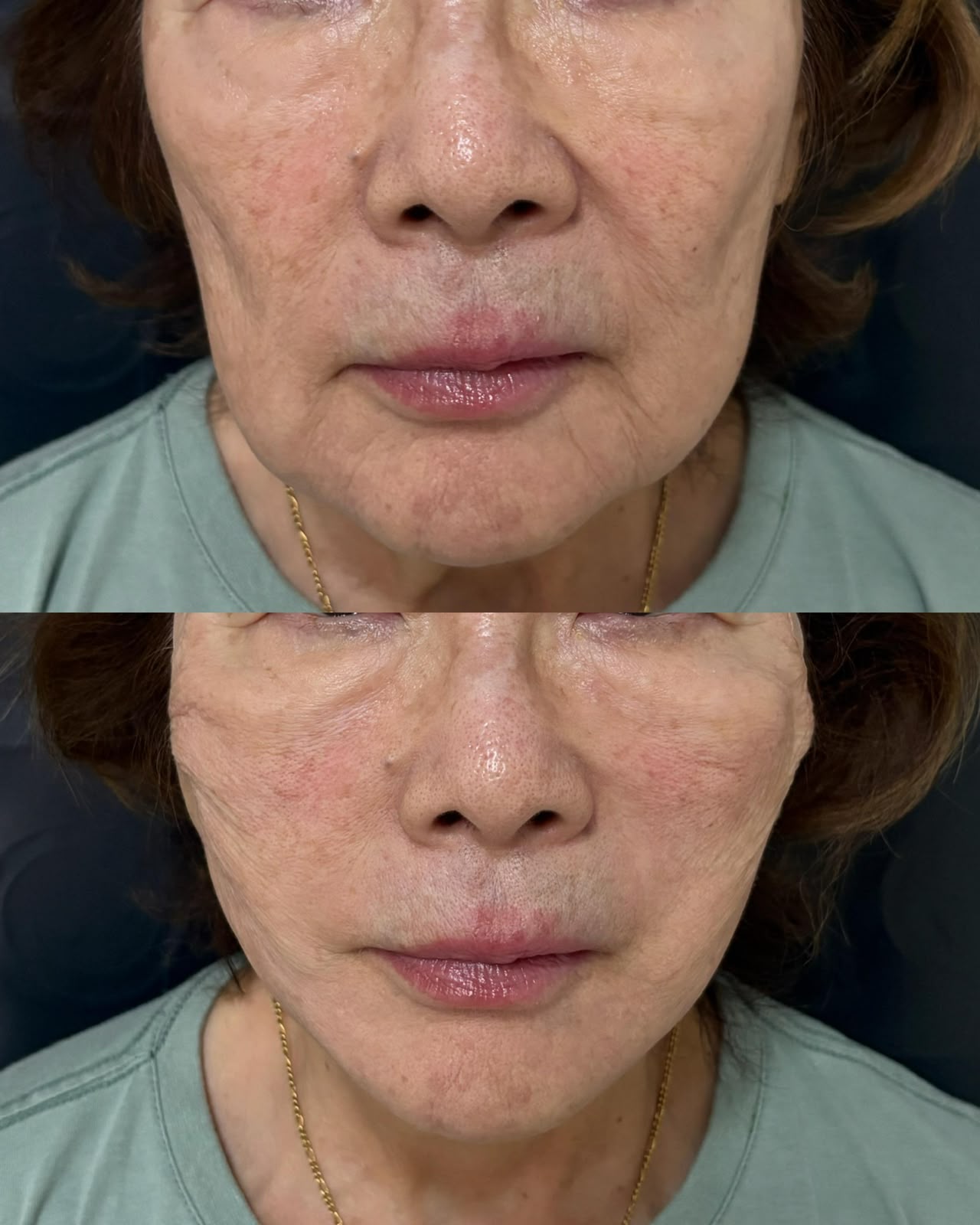 Botox Full Face em Porto Velho - RO — Fabiana Rocha Centro de Estética